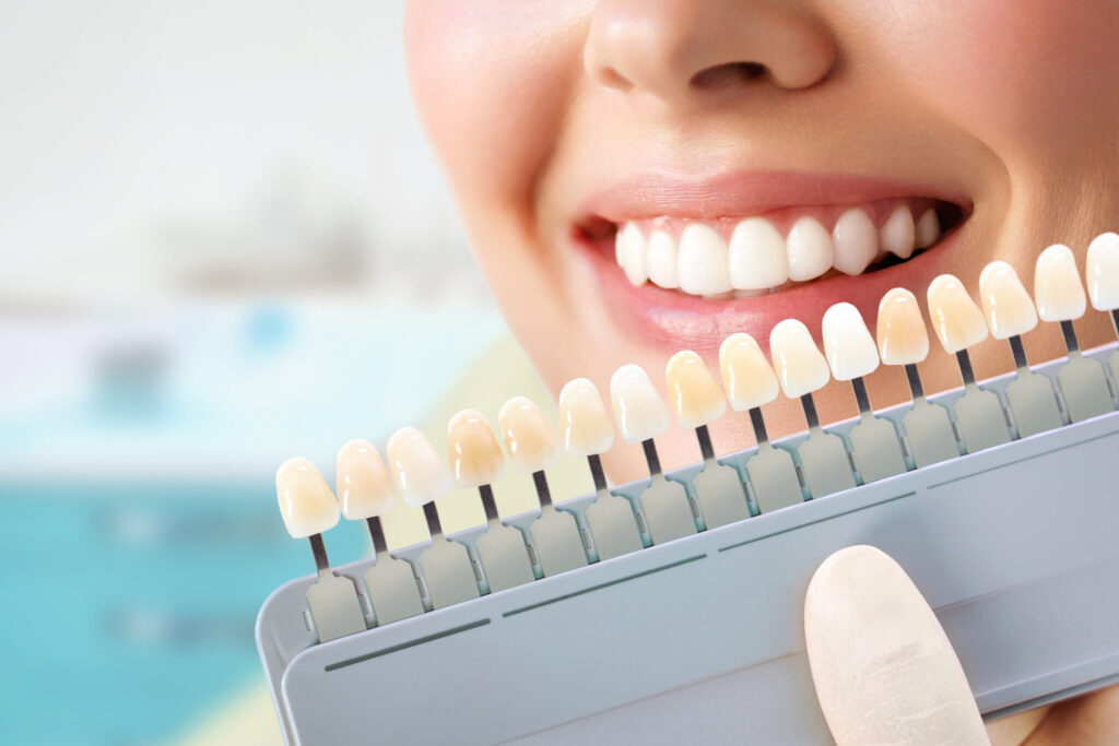 前歯を出した女性の歯の前で複数の歯の色の模型をかざし比べている
