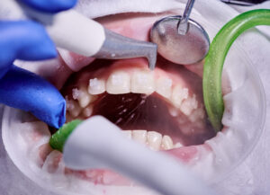 歯科医院での歯の洗浄