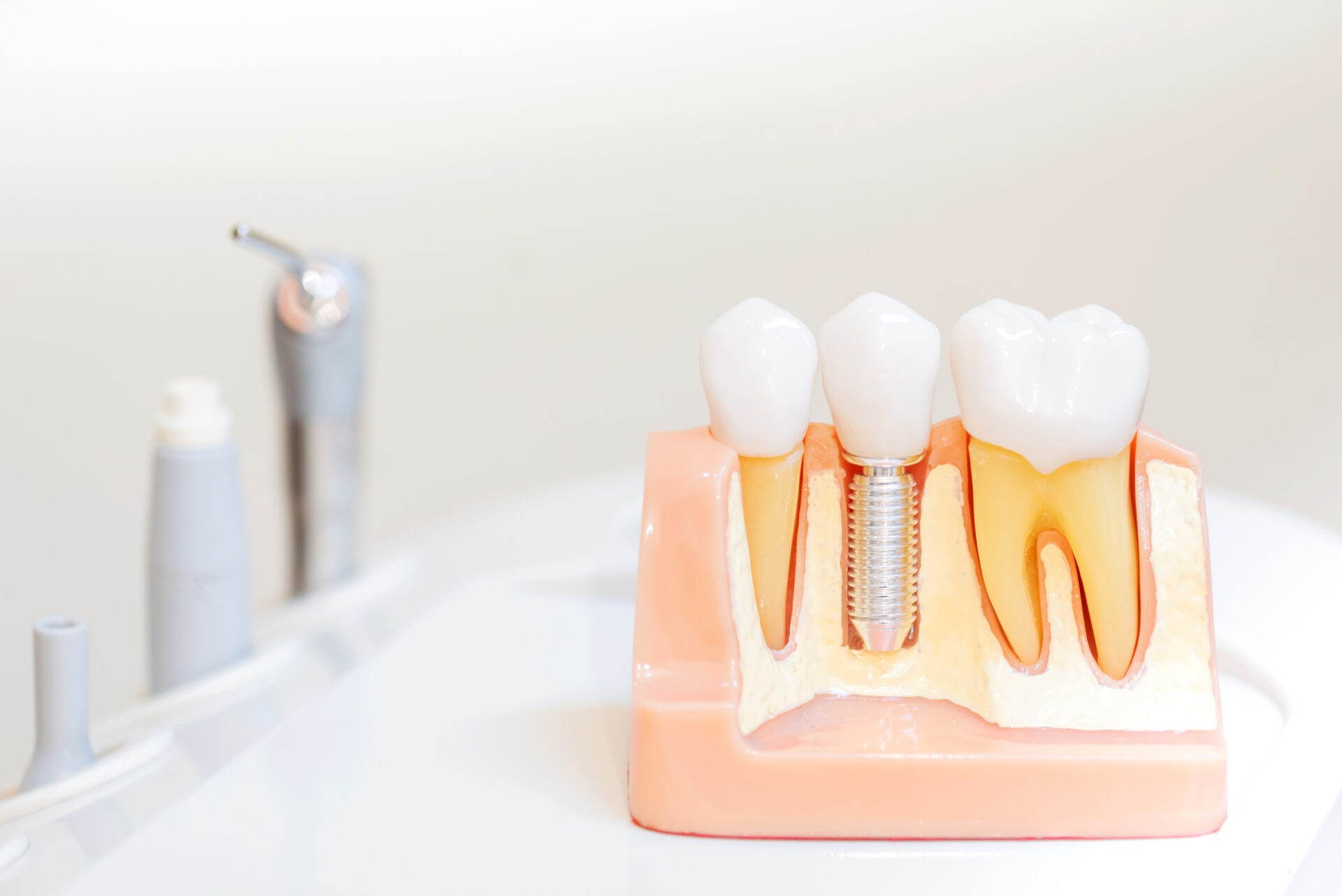 机の上に置かれたインプラントの模型と歯科用器具